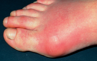 pengobatan gout di kaki  karena penyakit asam  urat  Obat 